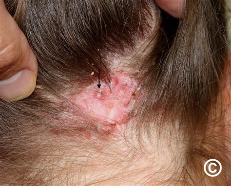 Pityrosporum Folliculitis Scalp