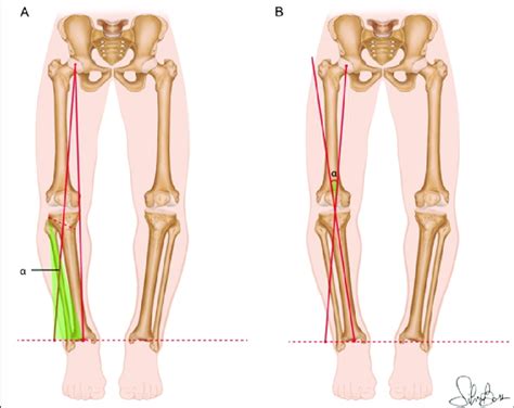 Diagram Of The Planning Method For Knee Osteotomy According To A