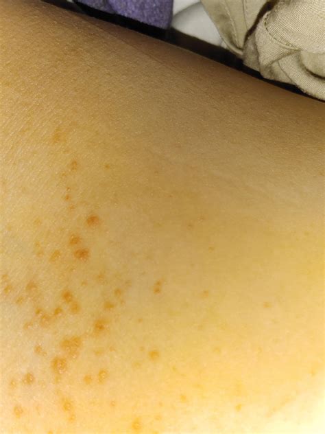Inner Thigh Bumps What Could It Be Rdermatology