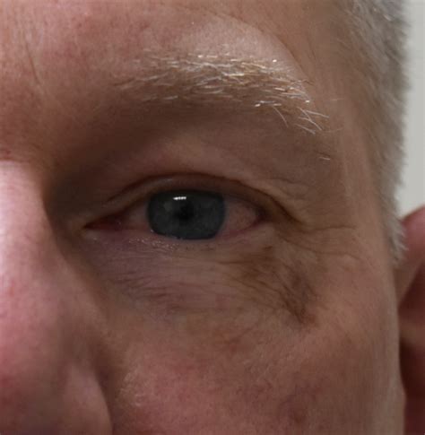 Figure Melanoma In Situ Involving The Left Lower Eyelid Contributed