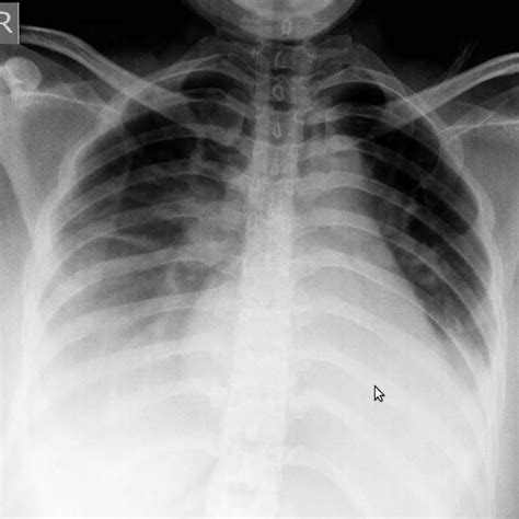 X Ray Chest Pa Of The Patient After 2 Days Showing Bilateral Pneumonia