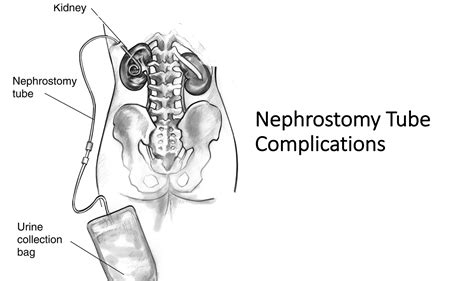 Emergency Medicine Educationcomplications Of Nephrostomy
