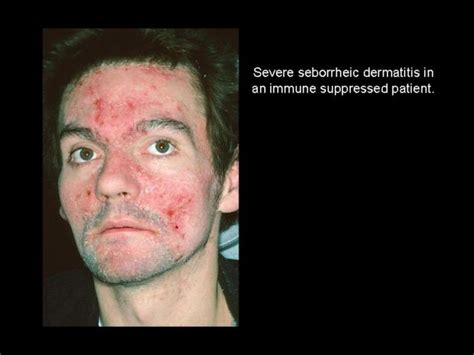 Seborrheic Dermatitis Pulmonology Advisor