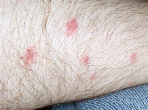 Red Dots On Legs Pictures Symptoms Causes Treatment