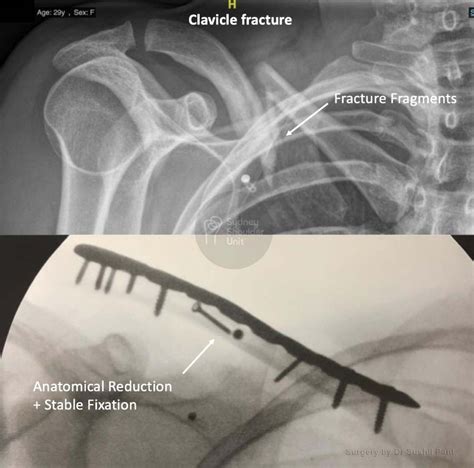 Broken Collarbone Surgery Shoulder Surgery Sydney Shoulder Unit