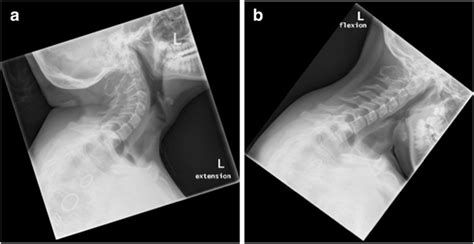 Radiographs Of The Cervical Spine In A Lateral Extension And B Flexion