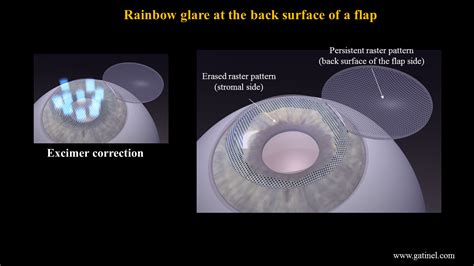 Rainbow Halos Around Lights After Cataract Surgery Americanwarmoms Org