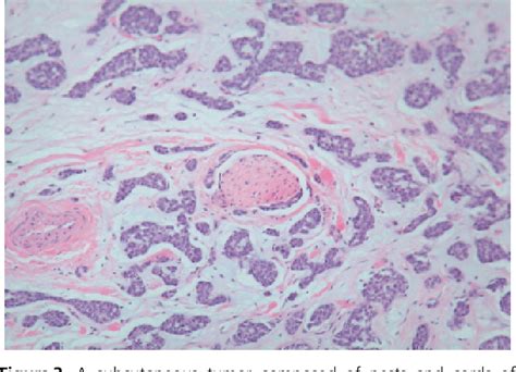 Figure 3 From Cutaneous Metastasis From Adenoid Cystic Carcinoma Of The