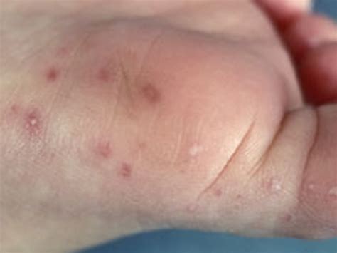 Hand Foot And Mouth Disease Cairns And Tablelands Childcare Centres