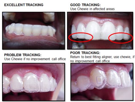 Invisalign Before And After Gap