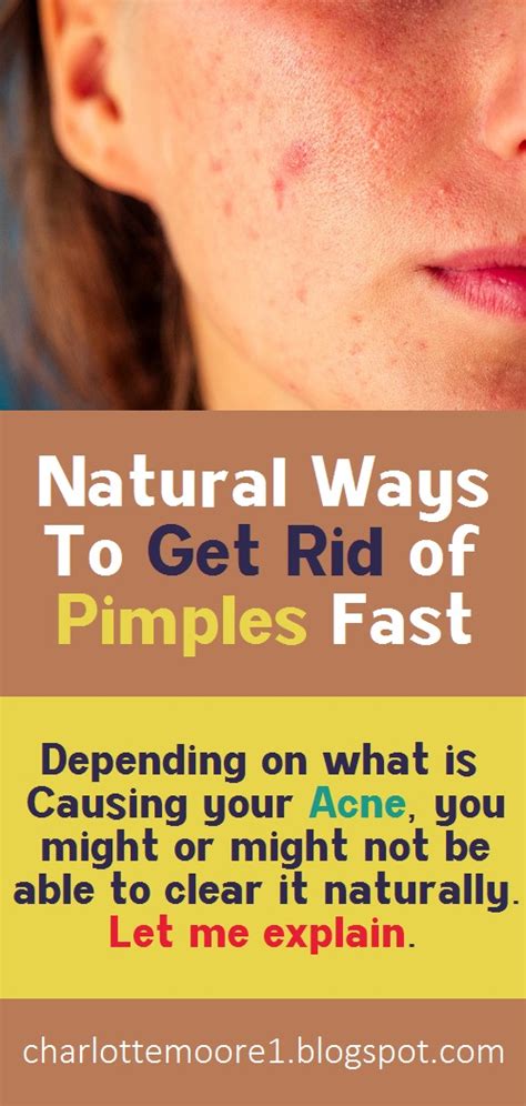Natural Ways To Get Rid Of Pimples Fast Charlotte Moore