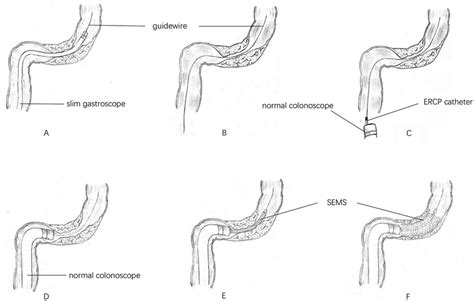 Stent Placement Assisted By A Slim Gastroscope Without X Ray Ercp