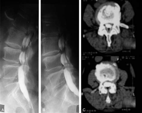A Preoperative Myelogram B Preoperative Ct Finding L3 4 C