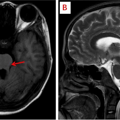 Brain Mri Showed Classic Findings Of Joubert Syndrome A Shows