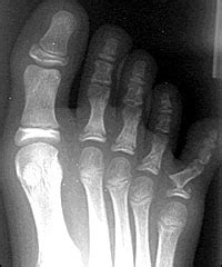 Evaluation and Management of Toe Fractures - American ...