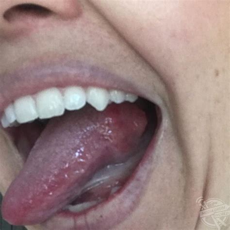 This Mum Had A Shock When A Bump On Her Tongue Ended Up Being Cancer