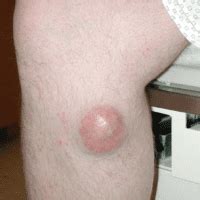 Most caused by merkel cell polyomavirus. Clinical Photos of Merkel Cell Carcinoma | Merkel Cell ...