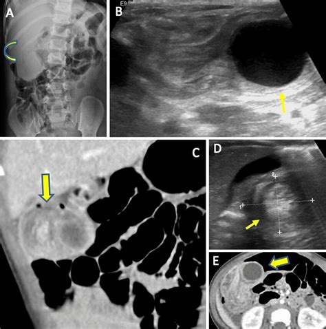 Duodenal Duplication Cyst Adult Female That Initially Presented For Download Scientific