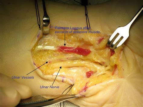 Release Of Compression Over Ulnar Nerve And Vessel At Guyons Canal