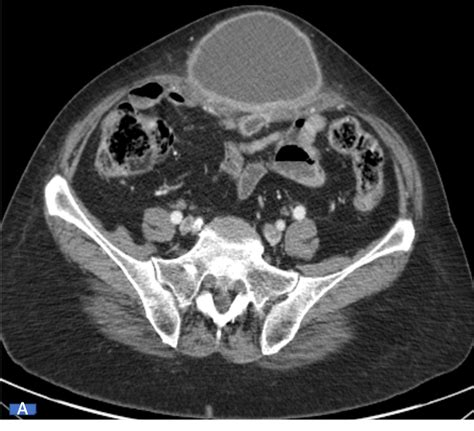 An Unexpected Infected Urachal Cyst Mimicking An Incarcerated Umbilical
