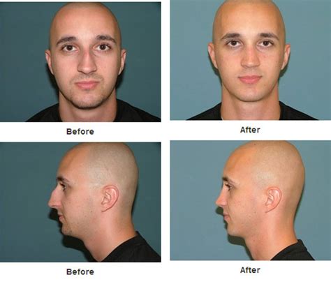 Insurance does not cover nose surgery for purely cosmetic reasons. Rhinoplasty or Nose surgery is a procedure that starts ...