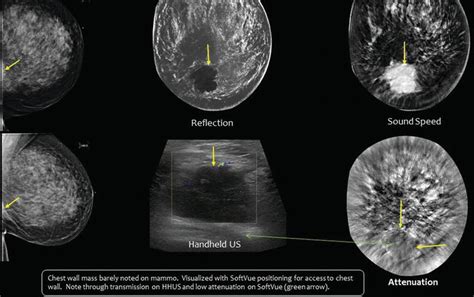 Breast Ultrasound Tomography Intechopen