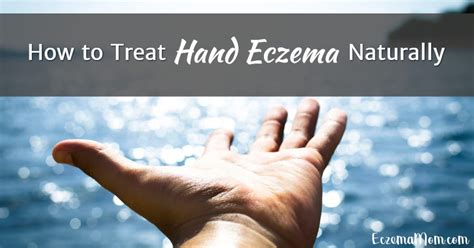 How To Treat Hand Eczema Naturally Ilovenaturalstore