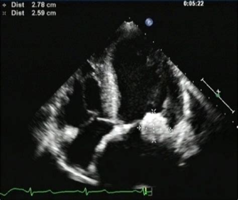 Calcified Amorphous Tumor Of Mitral Annulus Treated By Simple