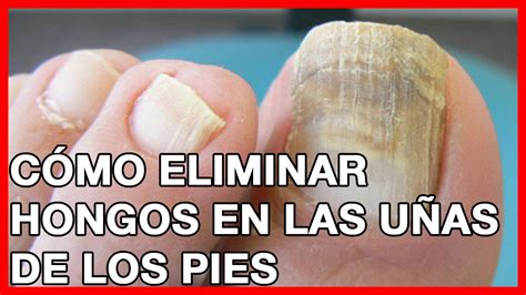 Como Curar Hongos En Las Uñas Delos Pies En Niños 2023