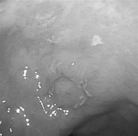 Esophagogastroduodenoscopy Showing A Small Superficial Elevated Lesion