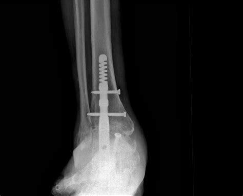When Is An Ankle Fusion A Better Idea Than An Ankle Replacement Foot