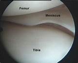 Recovery From Biceps Tenodesis Arthroscopy Surgery Photos