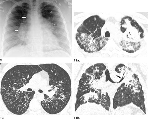 Pulmonary Manifestations Of Sarcoidosis 9 Frontal Radiograph
