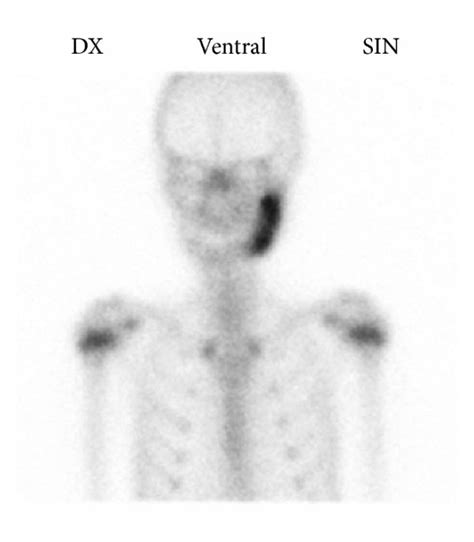 Bone Scintigraphy Of Patient Case 1 Shows Increased Uptake Of Tracer At