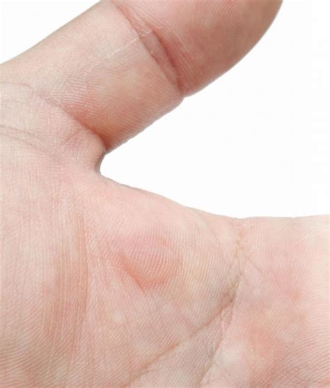 What Are The Different Types Of Remedies For Blisters