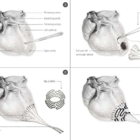 Drawing Of The Surgical Approach A Full Wall Incision Of The Left