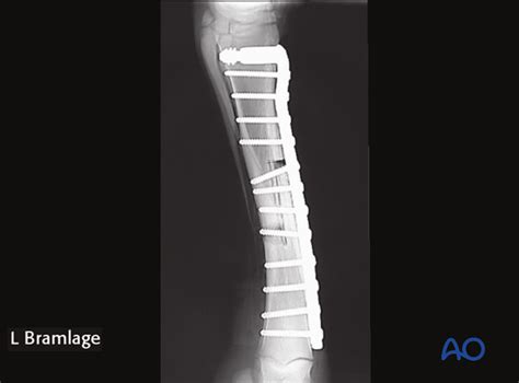 Corrective Osteotomy For Angular Limb Deformities