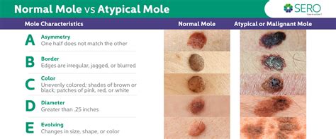 Atypical Moles Vs Precancerous Moles Vs Normal Moles Sero