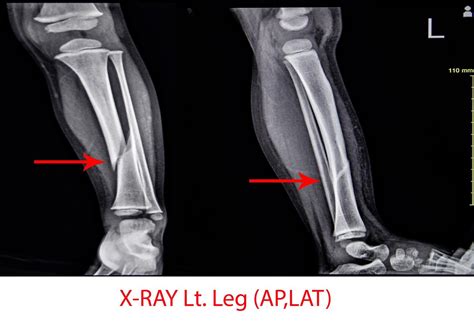 X Ray Left Leg Ap Lat Fracture Tibia 15763232 Stock Photo At Vecteezy