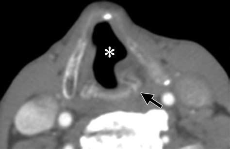 Unilateral Vocal Cord Paralysis A Review Of Ct Findings Mediastinal