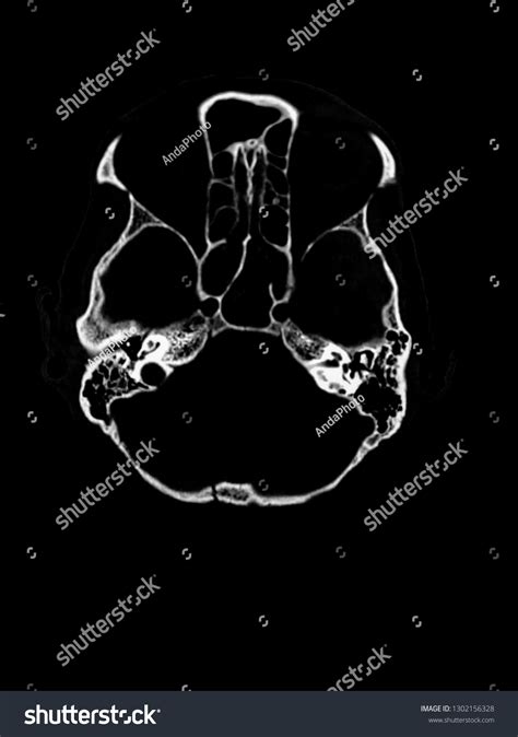Ct Scan Skull Fracture Occipital Bone库存照片1302156328 Shutterstock