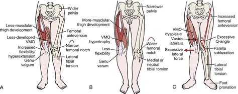 Pin by Rob on Massage Technique/ NMT | Bow legged correction, Bow