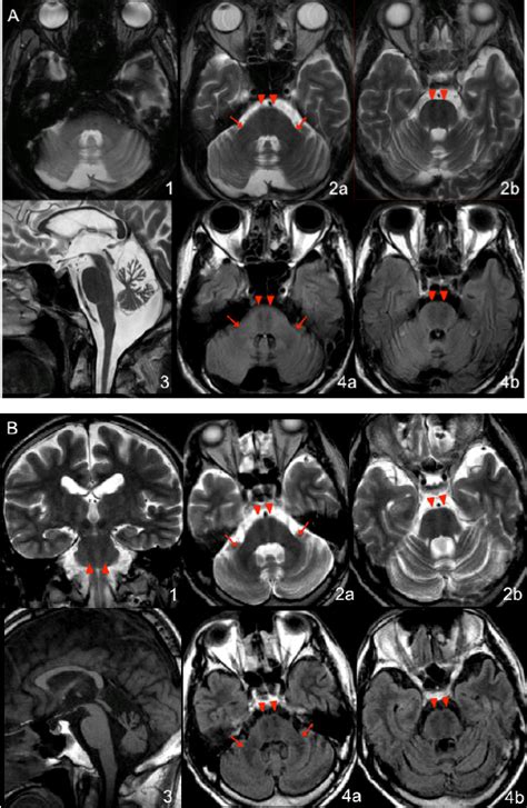 Representative Brain Mri Findings In Two Arsacs Patients T2 Weighted