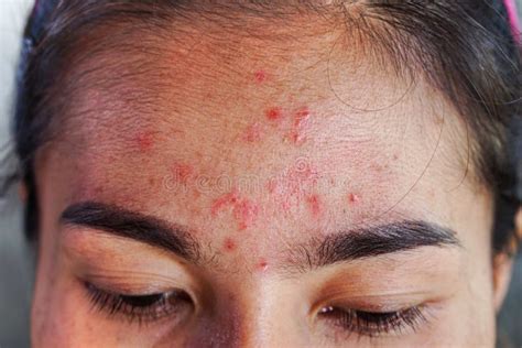 Closeup Acne On Forehead Of Asian Woman Teen Face With Rash Skin