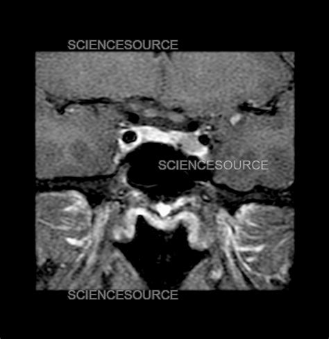 Mri Of Pituitary Microadenoma Stock Image Science Source Images