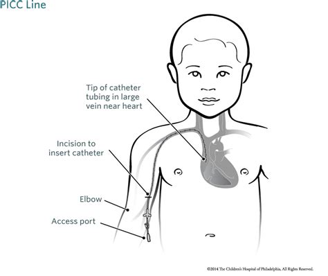 One of the goals of intermountain healthcare is to ensure you feel comfortable caring for your child once you go home. Pin on Catheter Connection