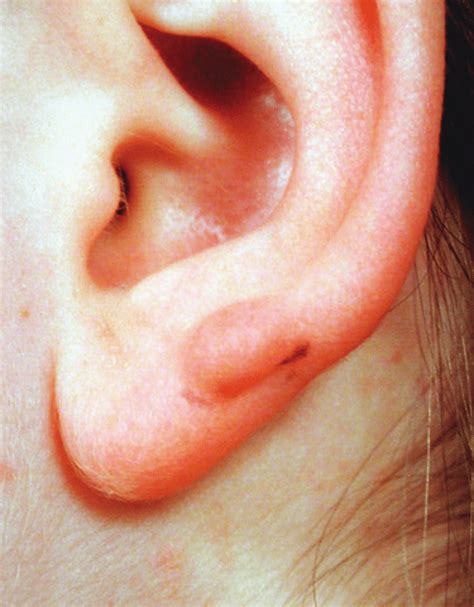 Auricular Prominence In The Lower Ear Showing A Sulcus On The Posterior