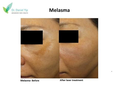 Melasma Dr Daniel Yip Restorative Skin Care Health