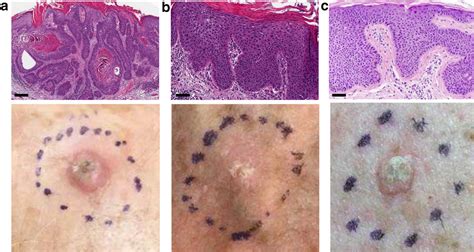 Electrical Impedance Dermography Differentiates Squamous Cell Carcinoma