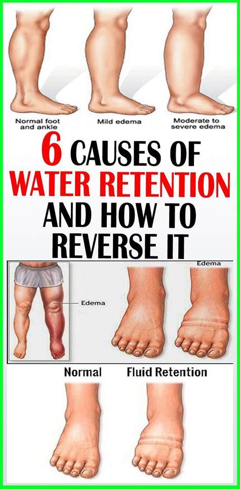 6 Causes Of Water Retention And How To Reverse It In 2020 Water